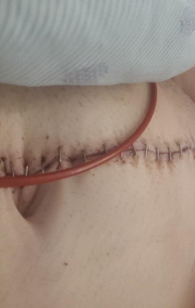 Cancer survivor wakes up from surgery without his right eye and confused by multiple scars